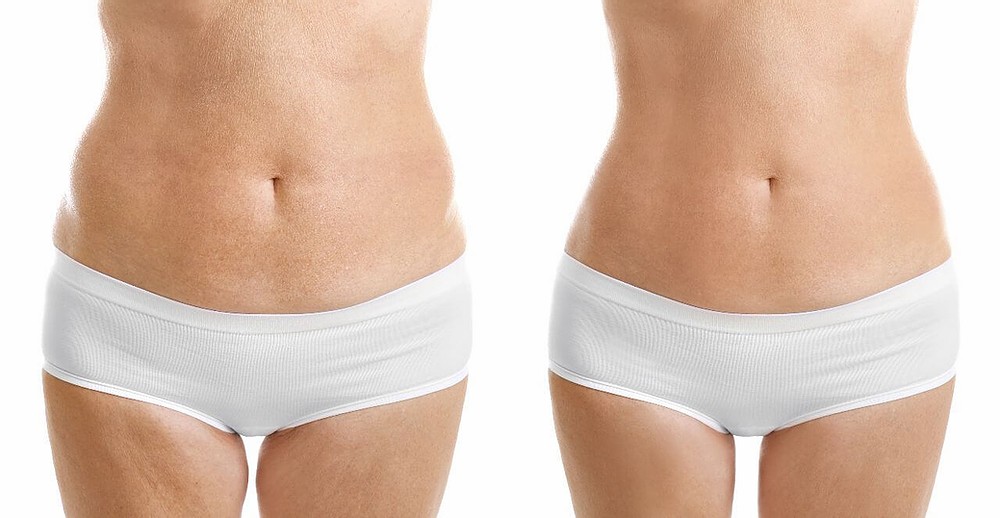 Hidrolipoclasia