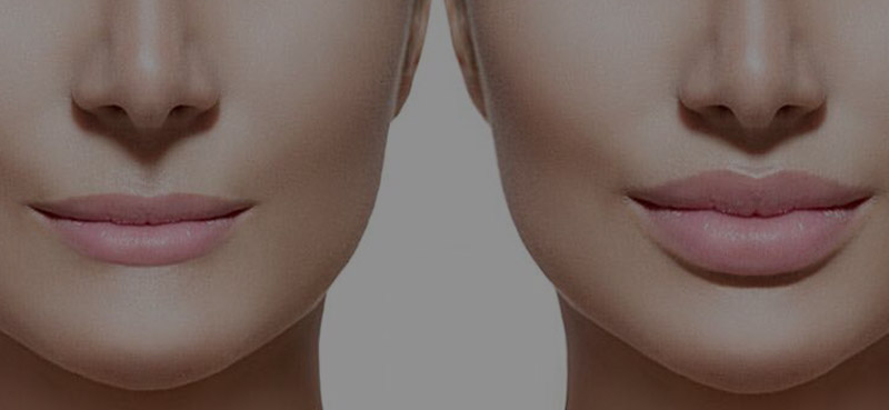 Lip Lift