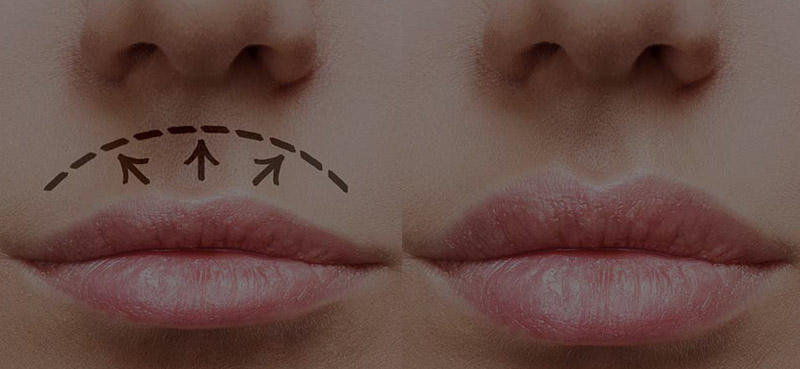 Lip Lift
