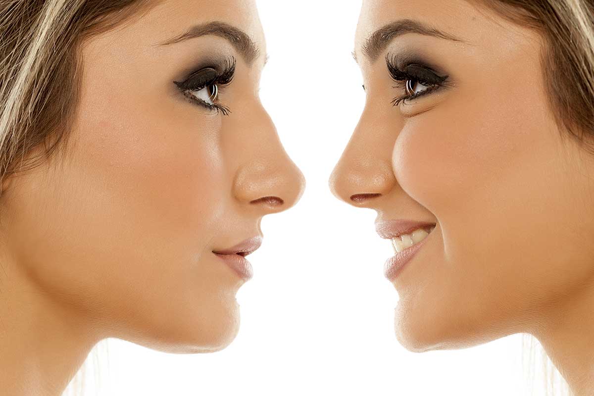 Rinoplastia Rinoplastia