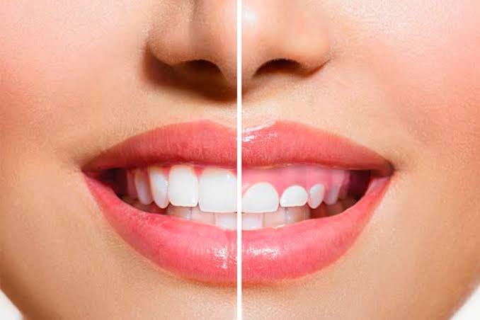 Sonrisa-gingival-2 Sonrisa-gingival-2