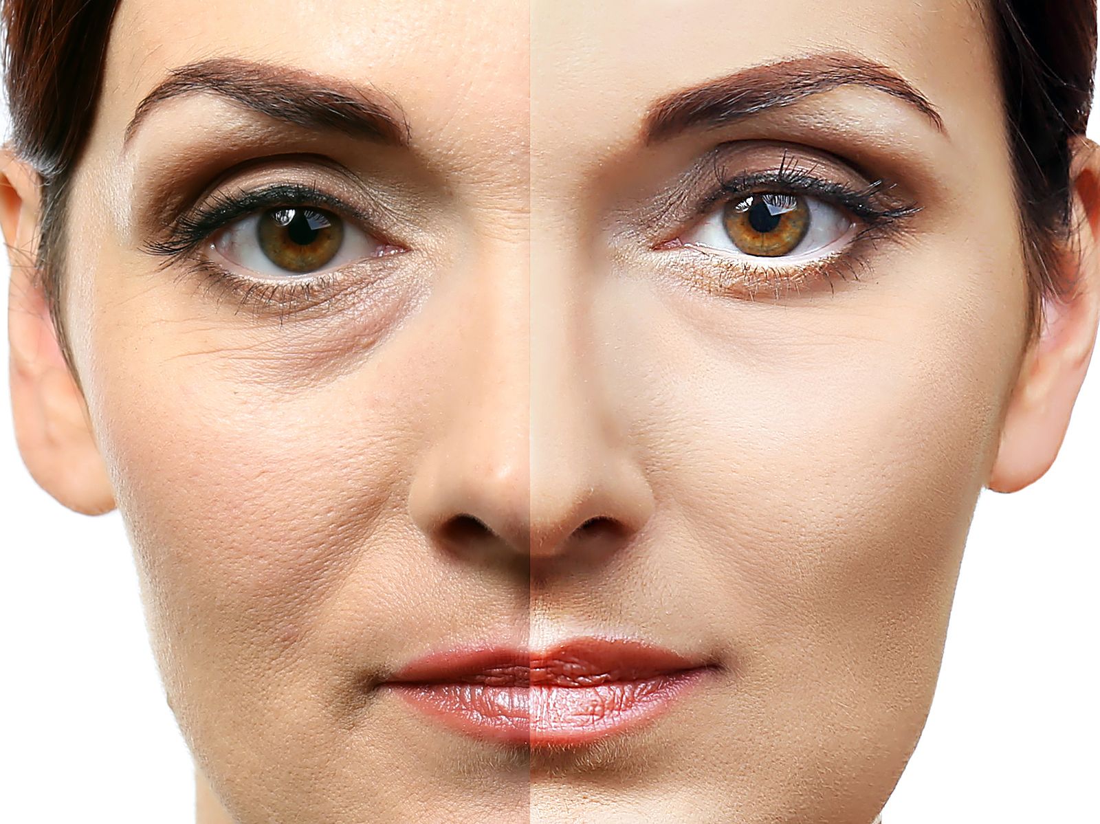 blefaroplastia-o-cirugia-de-parpados blefaroplastia-o-cirugia-de-parpados