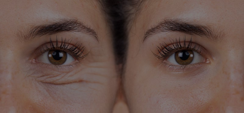blefaroplastia