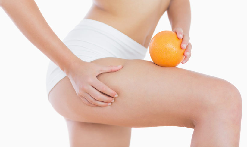celulitis--t