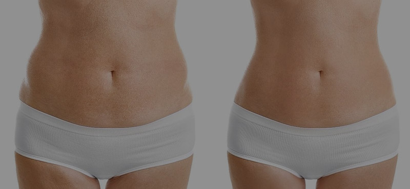 hidrolipoclasia