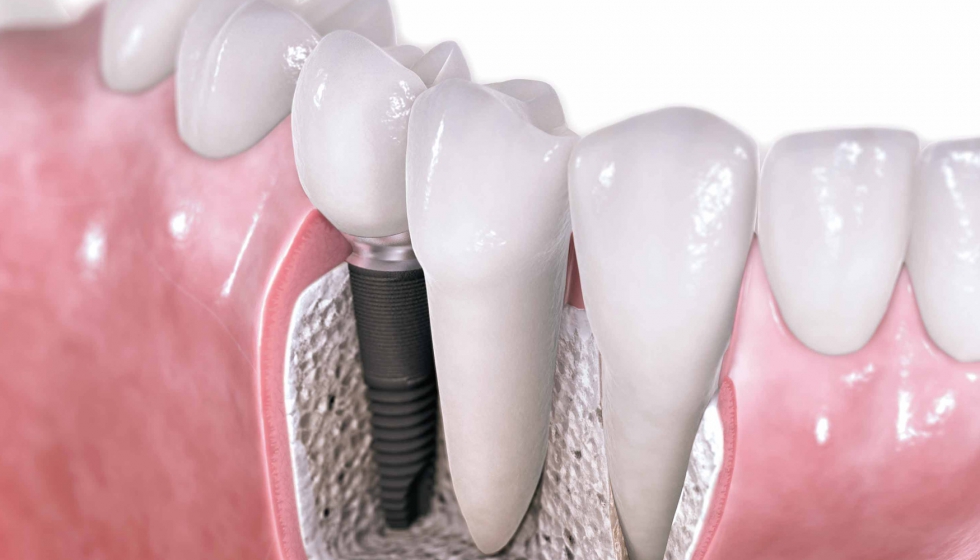 implantes implantes