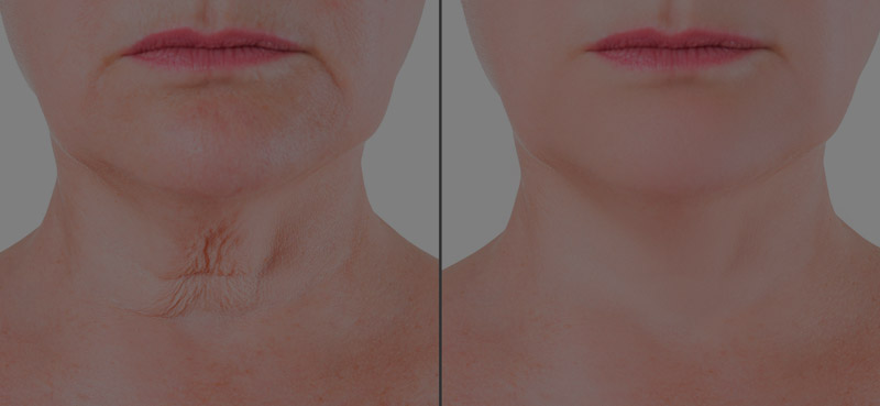 lifting de cuello