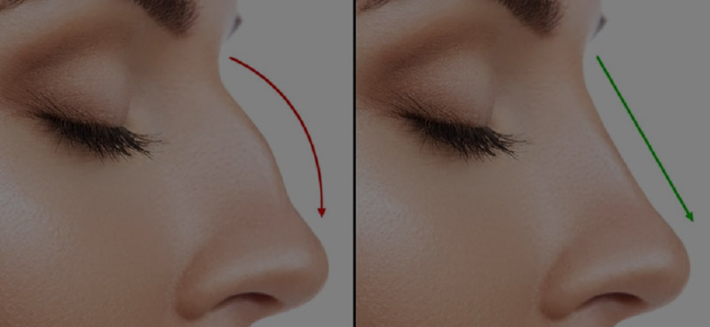 rinoplastia2