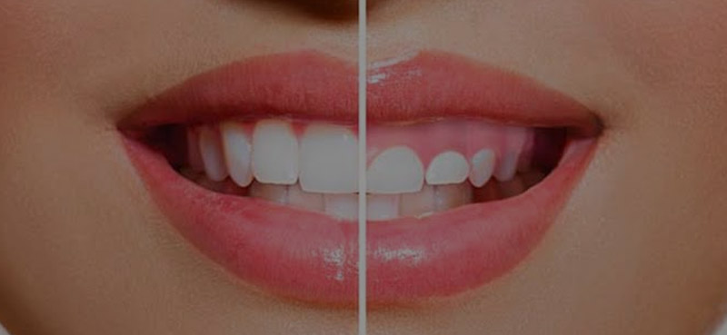 sonrisa gingival