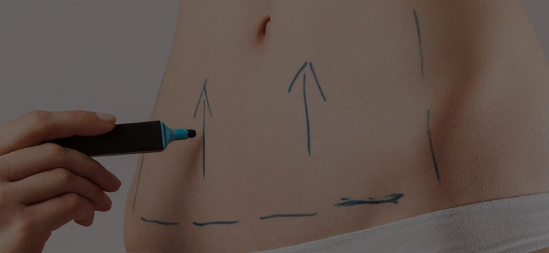 abdominoplastia