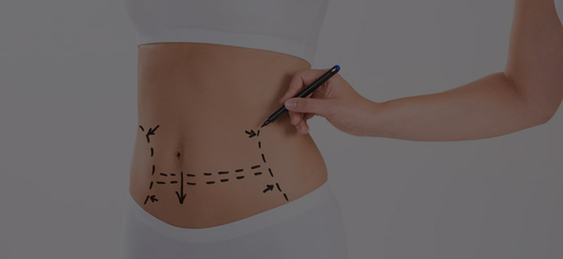 liposuccion