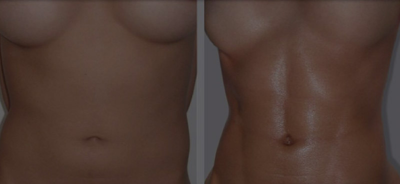 marcacion abdominal