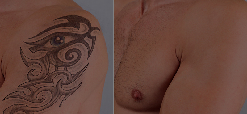 eliminacion-de-tatuajes