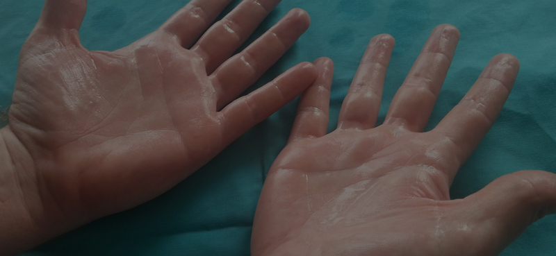 hiperhidrosis