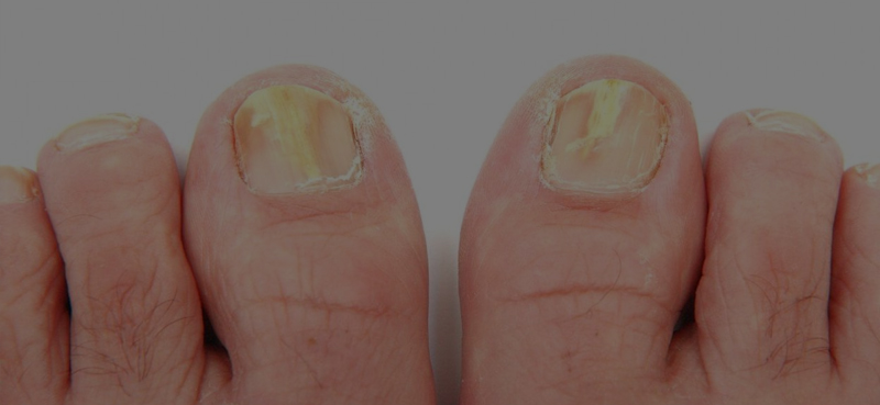onicomicosis